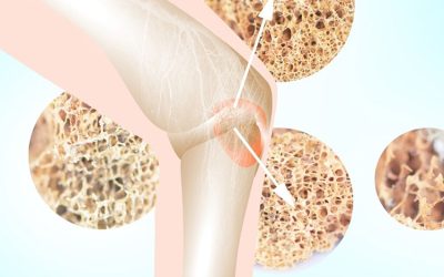 Pazienti in terapia per osteoporosi dal dentista a Rivoli e Caluso allo Studio Dentistico Rossi