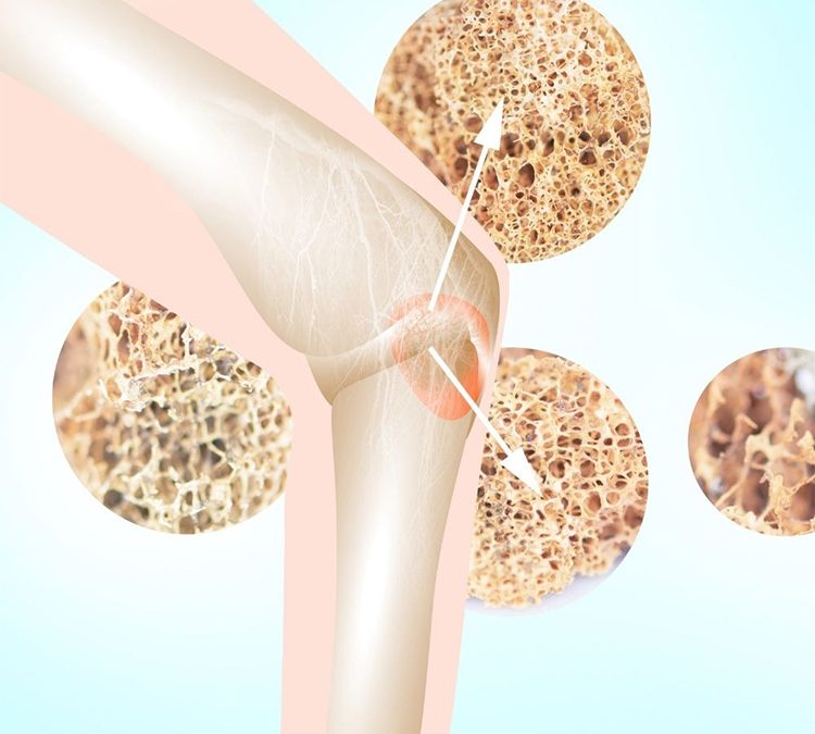 Pazienti in terapia per osteoporosi